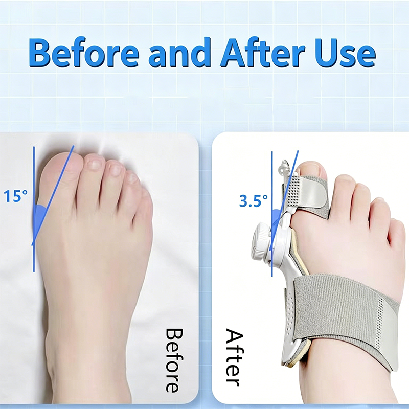 Multi-angle dial-adjustment bunion orthosis